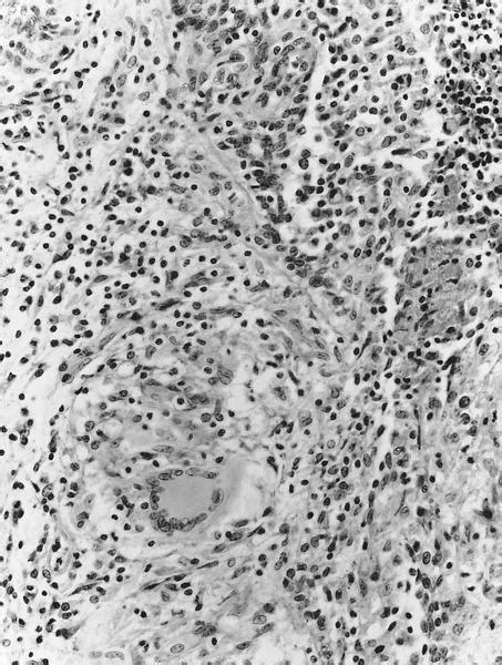 Pathology Outlines Tuberculosis