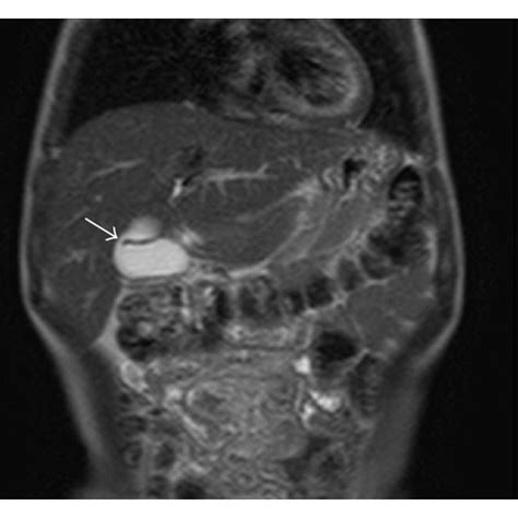 Cystic Dilatation Of The Cystic Duct Was Determined In Coronal Mrcp And