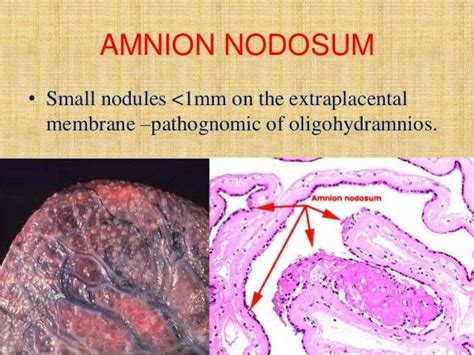 Amnion Nodosum ... #oligohydramnios | Beef, Food, Meat