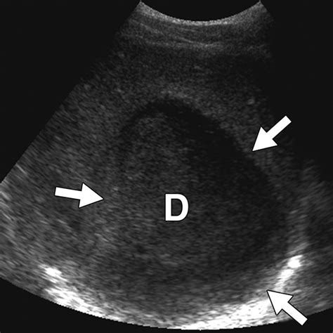 Focal Cystic Abdominal Masses In Pediatric Patients Ajr