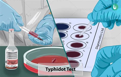 Typhidot Test Procedure Purpose Results Cost Price