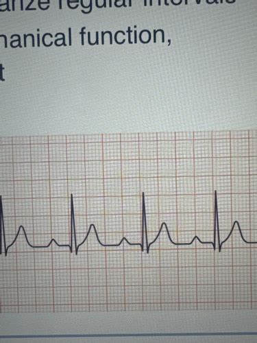 Patho Heart Conduction Flashcards Quizlet