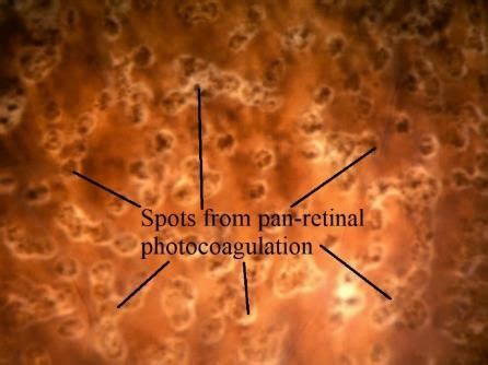 Moran Core Retina Rpe Histopathology