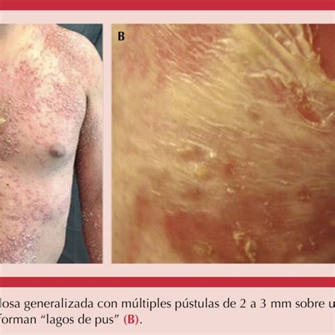 Cuadro 2 Criterios Diagnósticos De La Psoriasis Pustulosa Generalizada Download Scientific