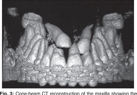 Figure 3 From Root Resorption Of Maxillary Incisors Caused By