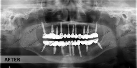 Do You Have Dental Bone Graft Cost and its Complications