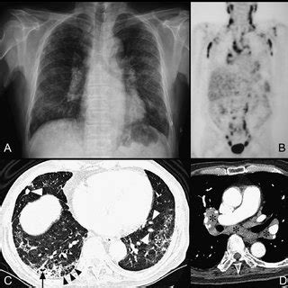 A Chest Radiograph Showing Mediastinal And Bilateral Hilar Enlargement