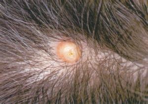 Boils on Scalp: Causes, Treatment, and Prevention for Boils on Your ...