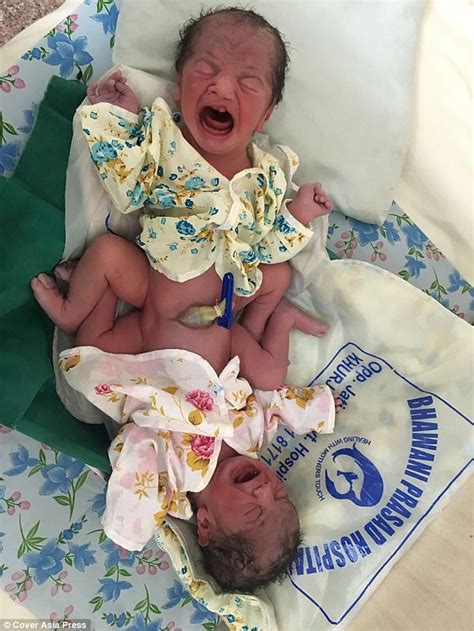 Indian Mum Of Conjoined Twins Told To Return To Hospital Daily Mail Online