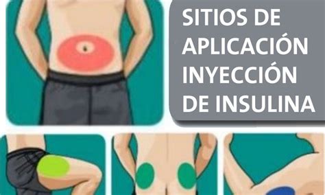 Ssa Difunde T Cnicas Para La Aplicaci N De Insulina Regionvalles