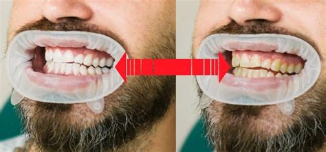 Sorriso Antes E Depois Do Clareamento Cuidados Odontol Gicos E