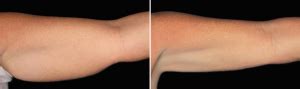 Velashape Before And After Vivalaser For You For All For Beauty