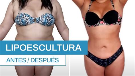 Cómo es una Lipoescultura Antes y después Clínica Barrenechea YouTube