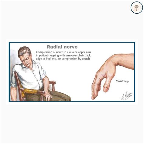 Radial Nerve Saturday Night Palsy In 2022 Radial Nerve Nerve Upper Arms