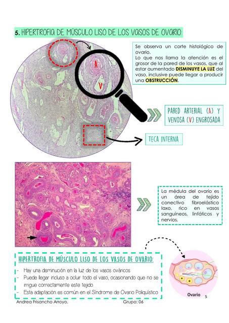 Necrosis E Inflamaci N Andrea Frisancho Arroyo Udocz