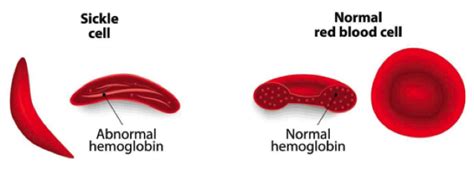 The Pharmacists Guide To Sickle Cell Disease — Tldr Pharmacy