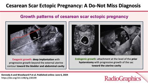 Cesarean Scar Ectopic Pregnancy A Do Not Miss Diagnosis Radiographics