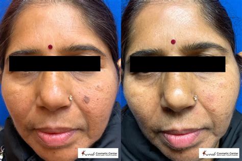 Seborrheic Keratosis Face Removal