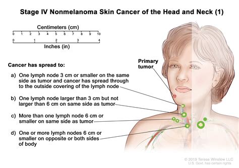 Skin Cancer Treatment (PDQ®)–Patient Version - Siteman Cancer Center