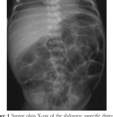 Figure 1 From Diagnostic Imaging Features Of Necrotizing Enterocolitis