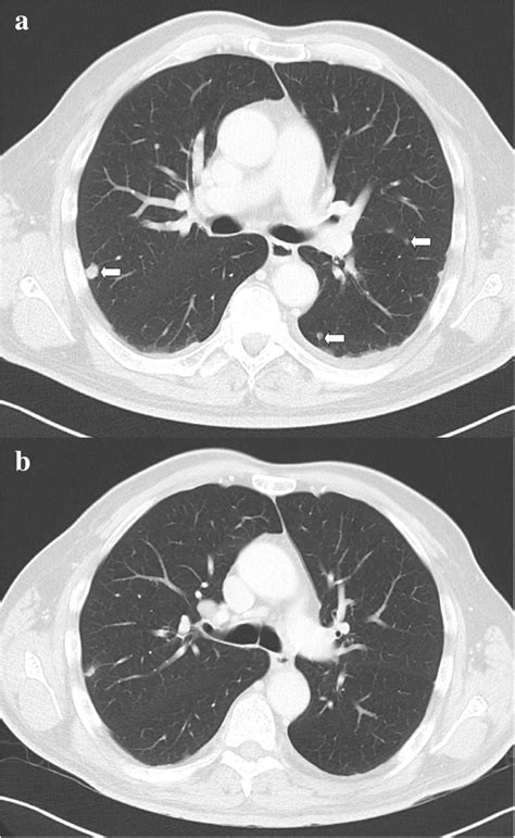 Axial Contrast Enhanced Computed Tomography Scans Of The Thorax Showing