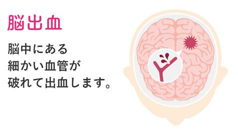 脳出血の意識レベルと回復について 再生医療脳梗塞・脊髄損傷の後遺症を幹細胞治療で改善ニューロテックメディカル