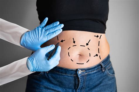 Vaser Hi Def Liposuction 2025 Medclinics