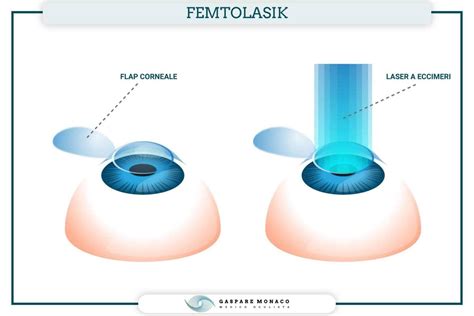 Laser Occhi Le Tecniche Chirurgiche I Costi E Il Recupero