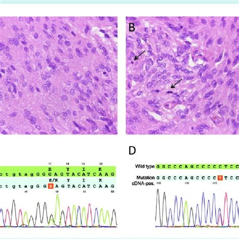 Molecular Versus Histological Diagnosis In Meningioma A A Meningioma Download Scientific