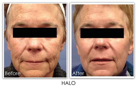 Halo Laser Skin Rejuvenation Clinic Skin Rejuvenation Clinic