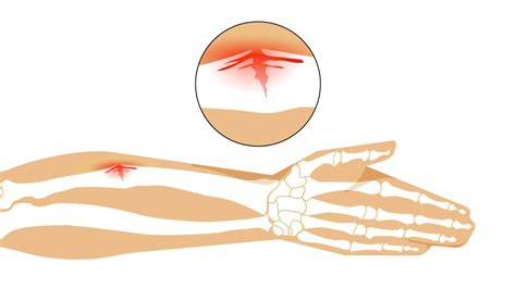 Fracturas en tallo verde en niños Dr Gallego Traumatología