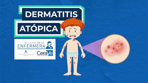 Cuidados En Dermatitis At Pica Youtube