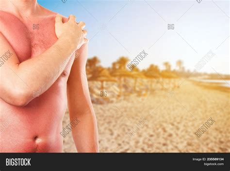 Man Sunburned Skin Sun Image And Photo Free Trial Bigstock