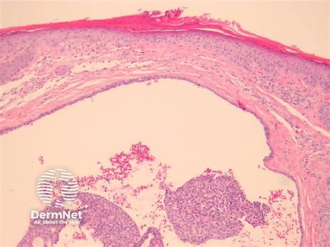 Endocrine Mucinproducing Sweat Gland Carcinoma Pathology