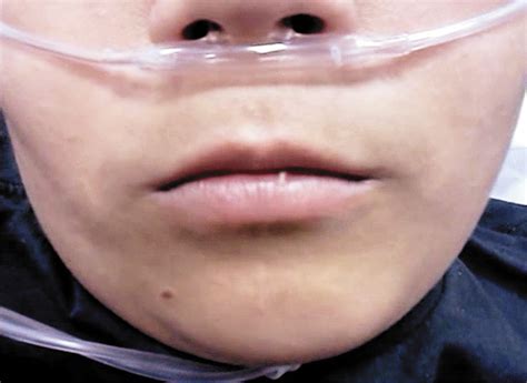 Myokymia