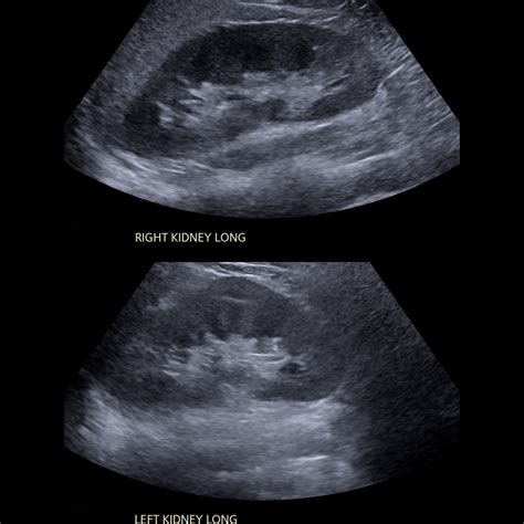 Normal Kidney Ultrasound