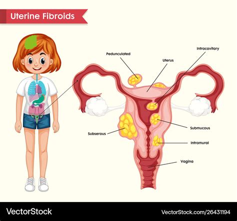 Scientific Medical Uterine Fibroids Royalty Free Vector