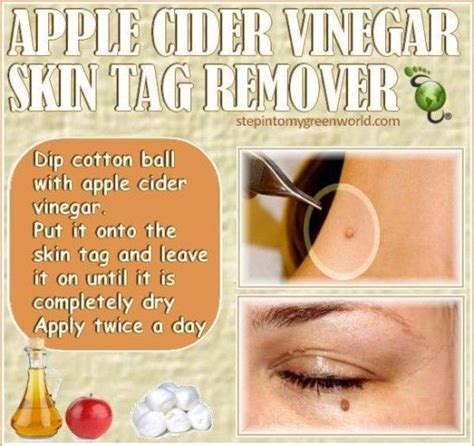 Albums 101 Pictures Apple Cider Vinegar Genital Wart Removal Pictures