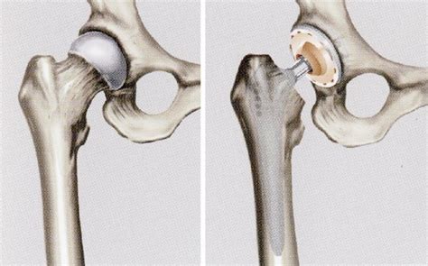 Knie und Hüftprothesen