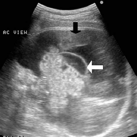 Pdf Meconium Peritonitis In Utero—the Value Of Prenatal Diagnosis In