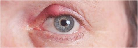 Eyelid Disease Blepharitis