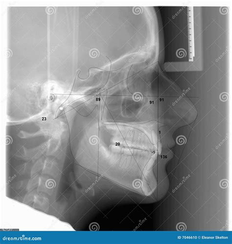 A Traced Cephalometric X Ray Stock Photo Image Of Orthodontic Ceph