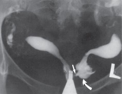 Hysterosalpingography In The Assessment Of Congenital Cervical