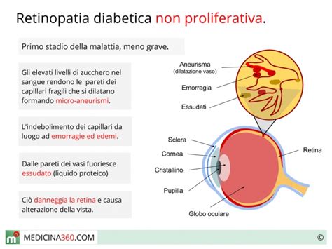 terra principale pezzo coda retinopatia diabetica stadi Armonioso montacarichi Umoristico