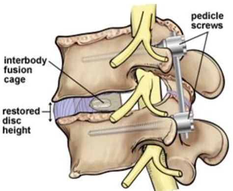 Posterior Lumbar Interbody Fusion Orthospine Advance Health Inc