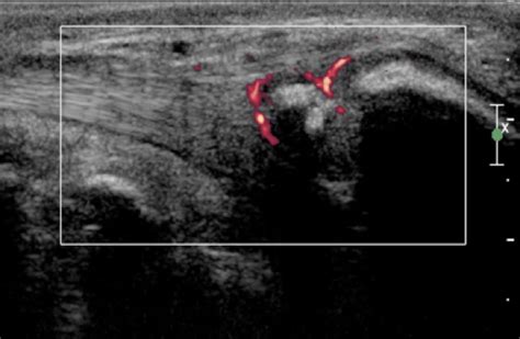 Posterior Tibial Tendon Ultrasound