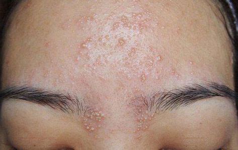 Home Acne Remedies For African Americans #acnevulgaris | Face mapping acne, Natural acne ...