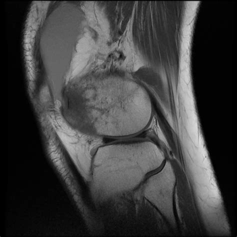 Transient Patellar Dislocation Image Radiopaedia Org