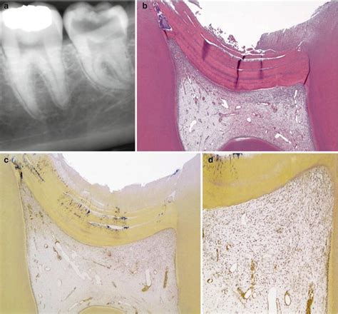 Pulp Inflammation From The Reversible Pulpitis To Pulp Necrosis During