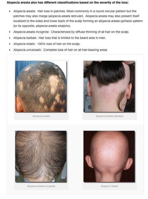 Diagram Types Of Alopecia Atelier Yuwa Ciao Jp